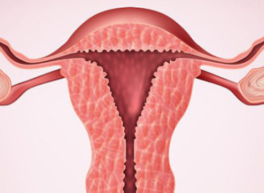 Endometrial Hiperplaziya nədir?